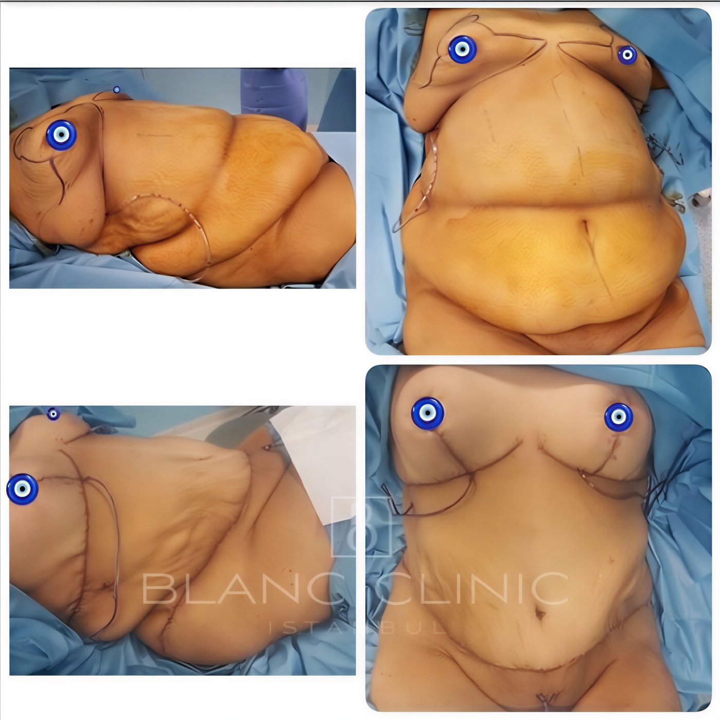Resultados de abdominoplastia antes y después en Blanc Clinic&Beauty, mejora abdominal visible