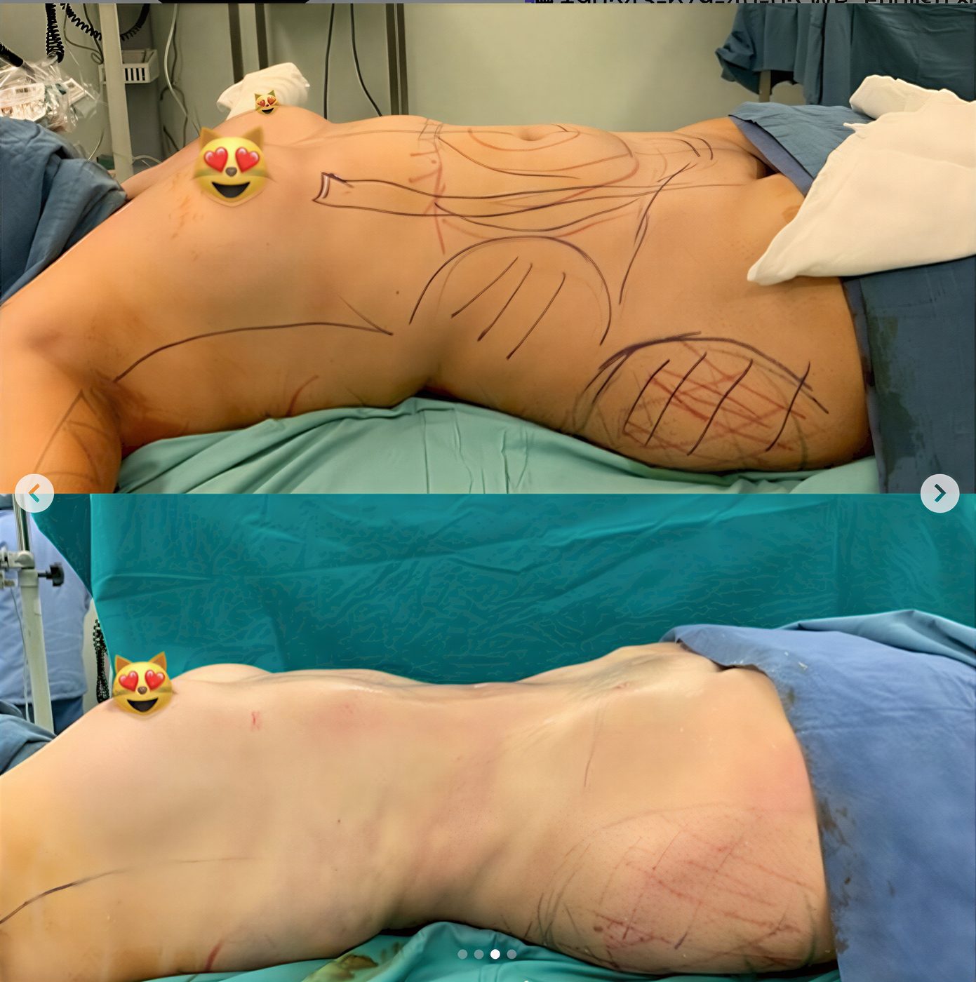 Resultados de abdominoplastia antes y después en Blanc Clinic&Beauty, mejora del contorno abdominal