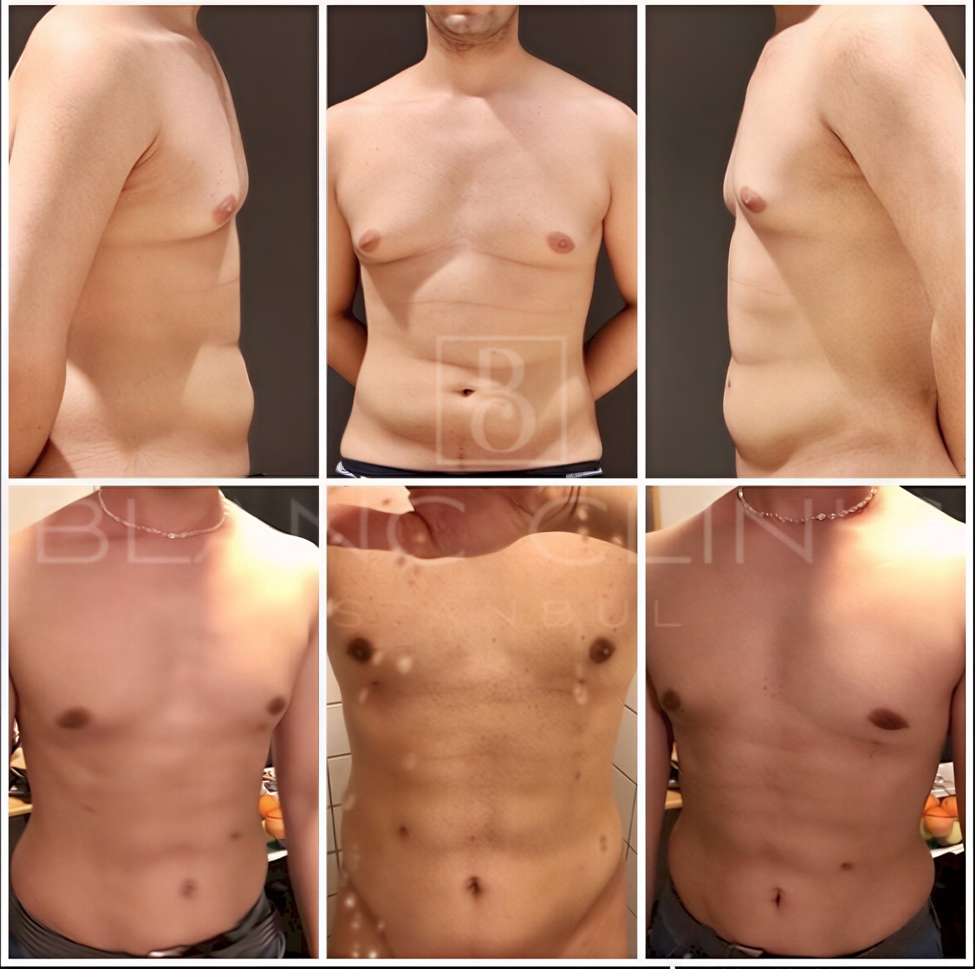 نتائج قبل وبعد شفط الدهون فايزر في Blanc Clinic&Beauty، تحسين شكل الجسم للرجال