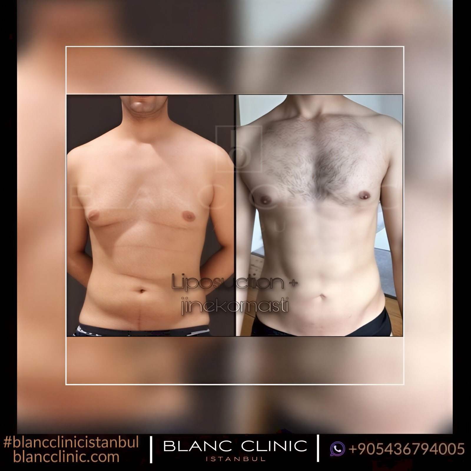 نتائج قبل وبعد شفط الدهون Vaser وعلاج التثدي في Blanc Clinic&Beauty