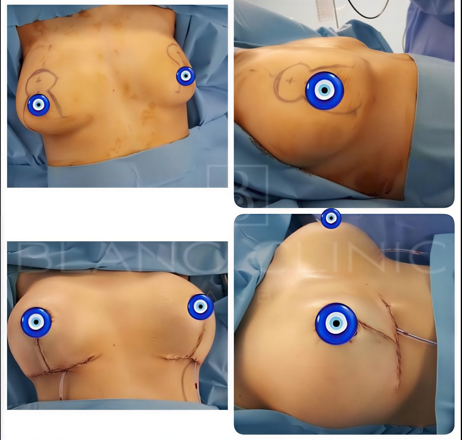Resultados de lifting de senos antes y después en Blanc Clinic&Beauty, mejor contorno visible