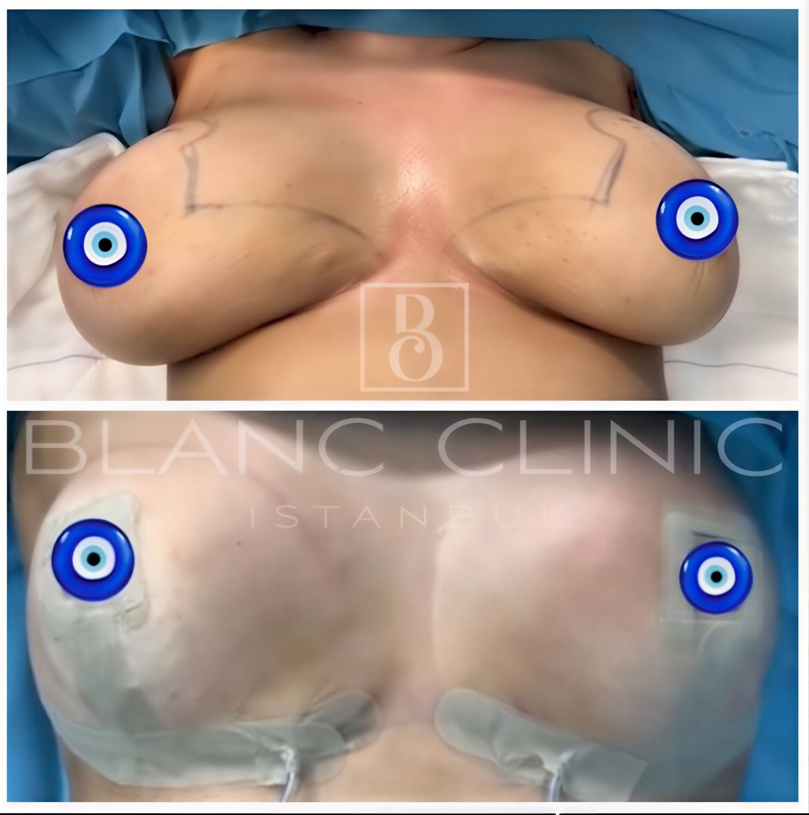 Resultados antes y después de lifting de senos en Blanc Clinic&Beauty, mejor contorno