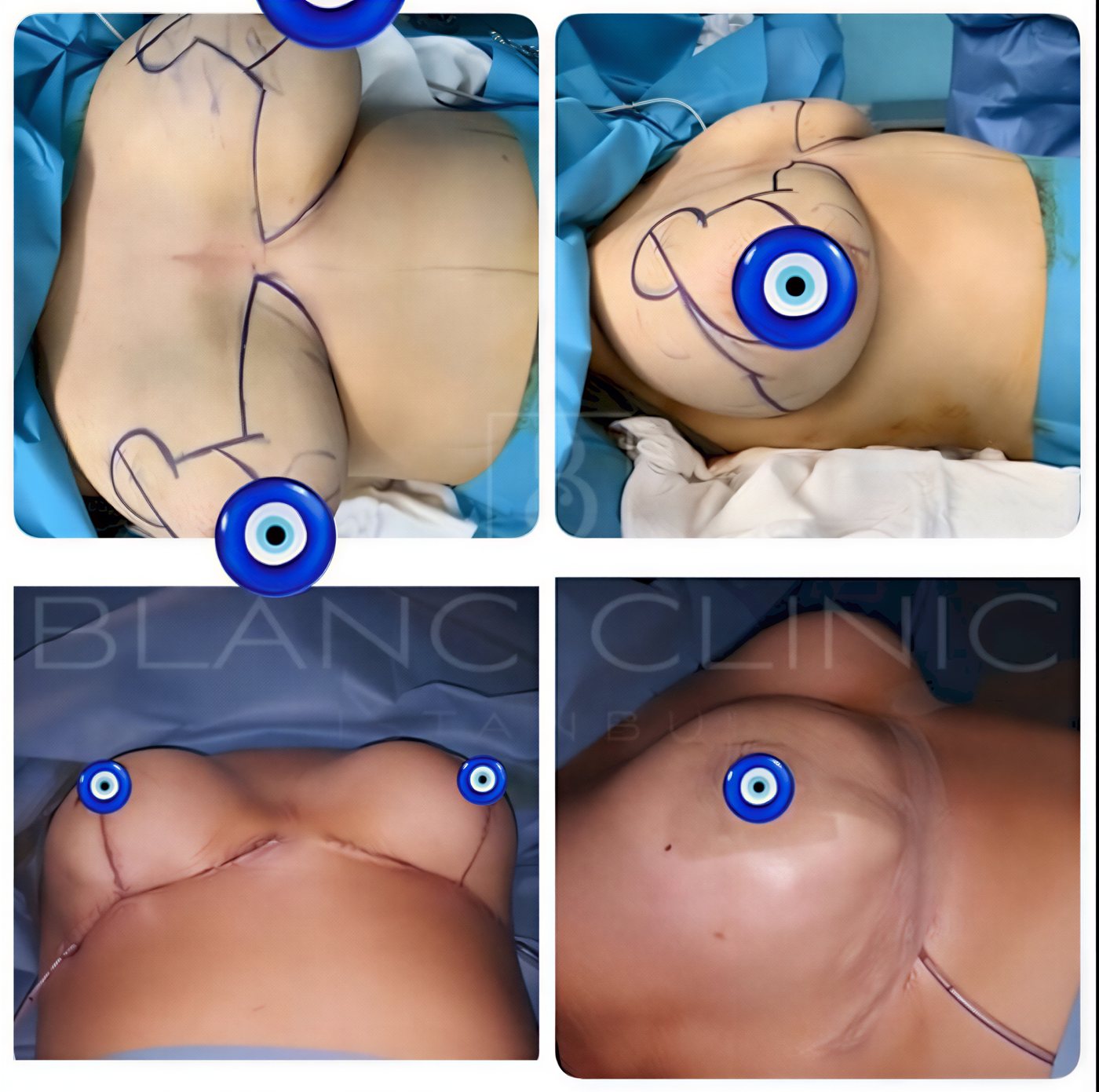 Resultados de lifting de senos antes y después en Blanc Clinic&Beauty, contorno mejorado