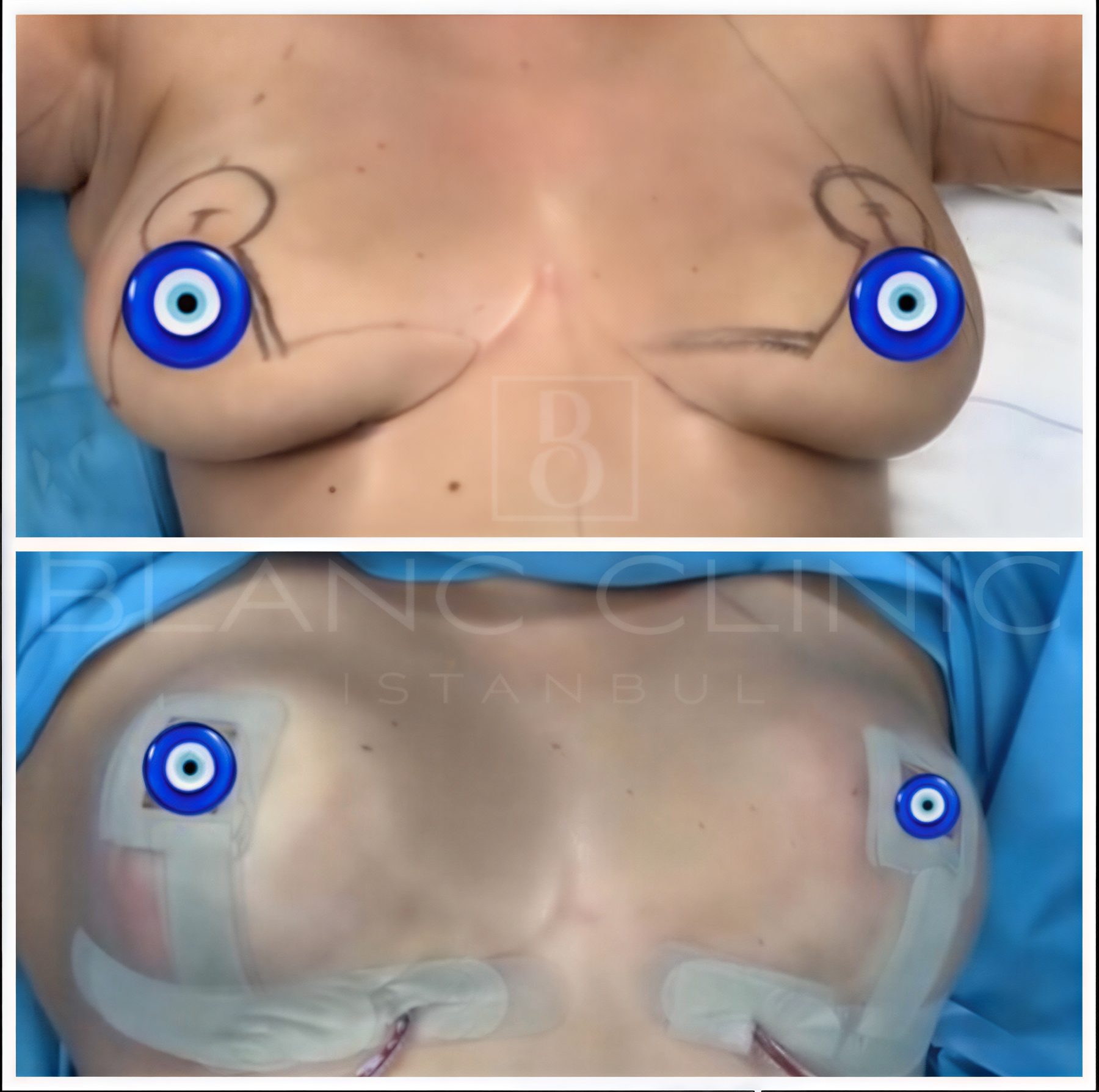 Resultados de lifting de senos antes y después en Blanc Clinic&Beauty, mejor contorno
