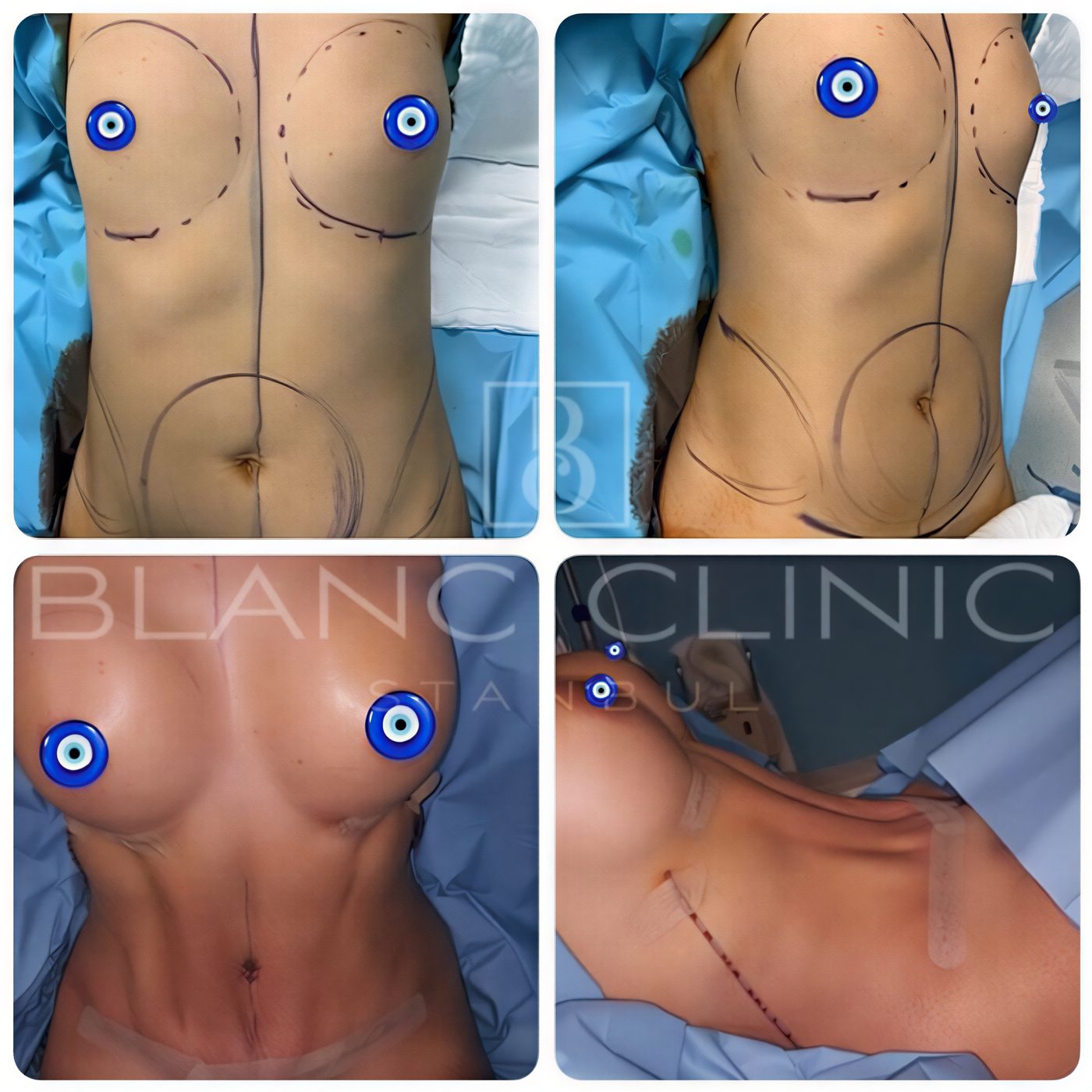 Resultados de abdominoplastia y aumento de senos antes y después en Blanc Clinic&Beauty