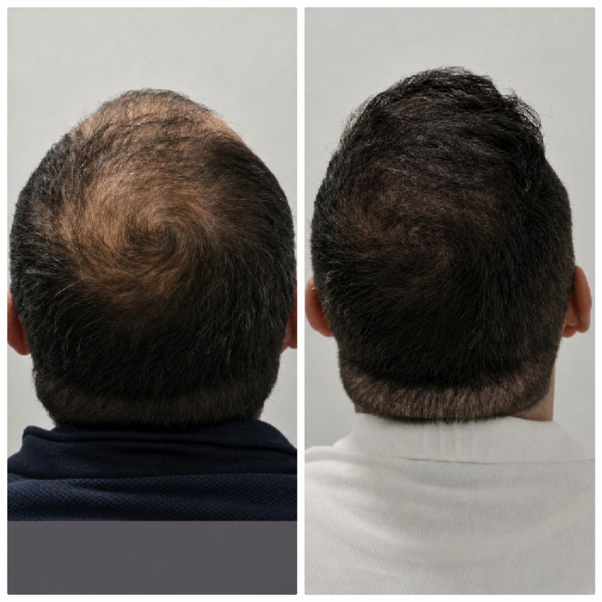 Resultados de trasplante capilar antes y después en Estemita Aesthetics Clinic del Dr. Hakan Ölmeztürk