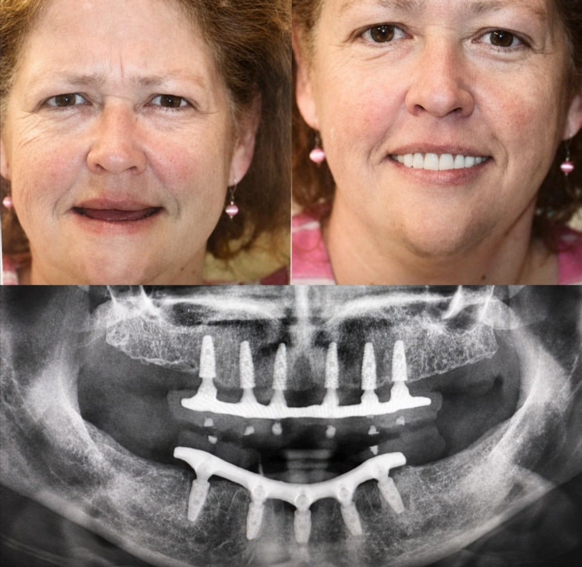 Before and after All-on-6 dental implants result at One Destination Clinic, smile restoration