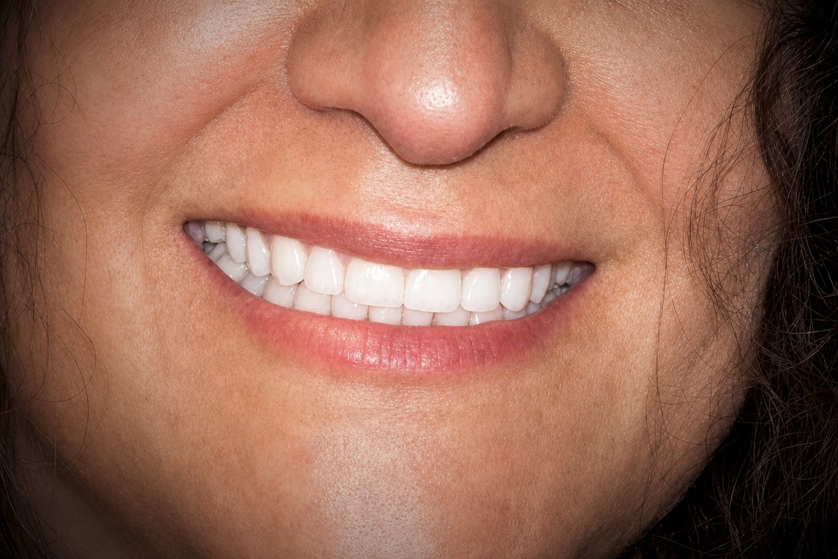Porcelain crown installation result at Dental Brush Clinic – improved smile aesthetics