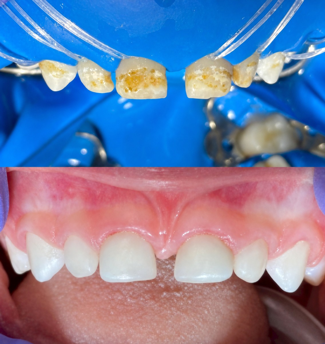 Before and after caries treatment results at Amel Dental Clinic, restored healthy teeth
