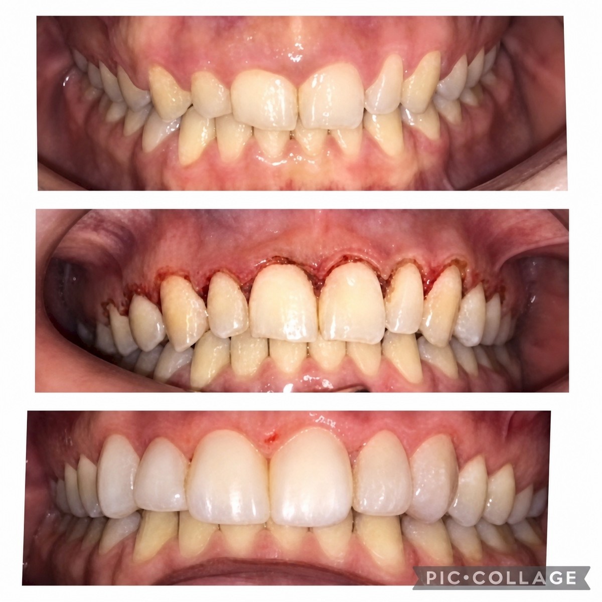 نتائج قبل وبعد فينير الكمبوزيت في Professional Dental Care Clinic، تحسين الابتسامة