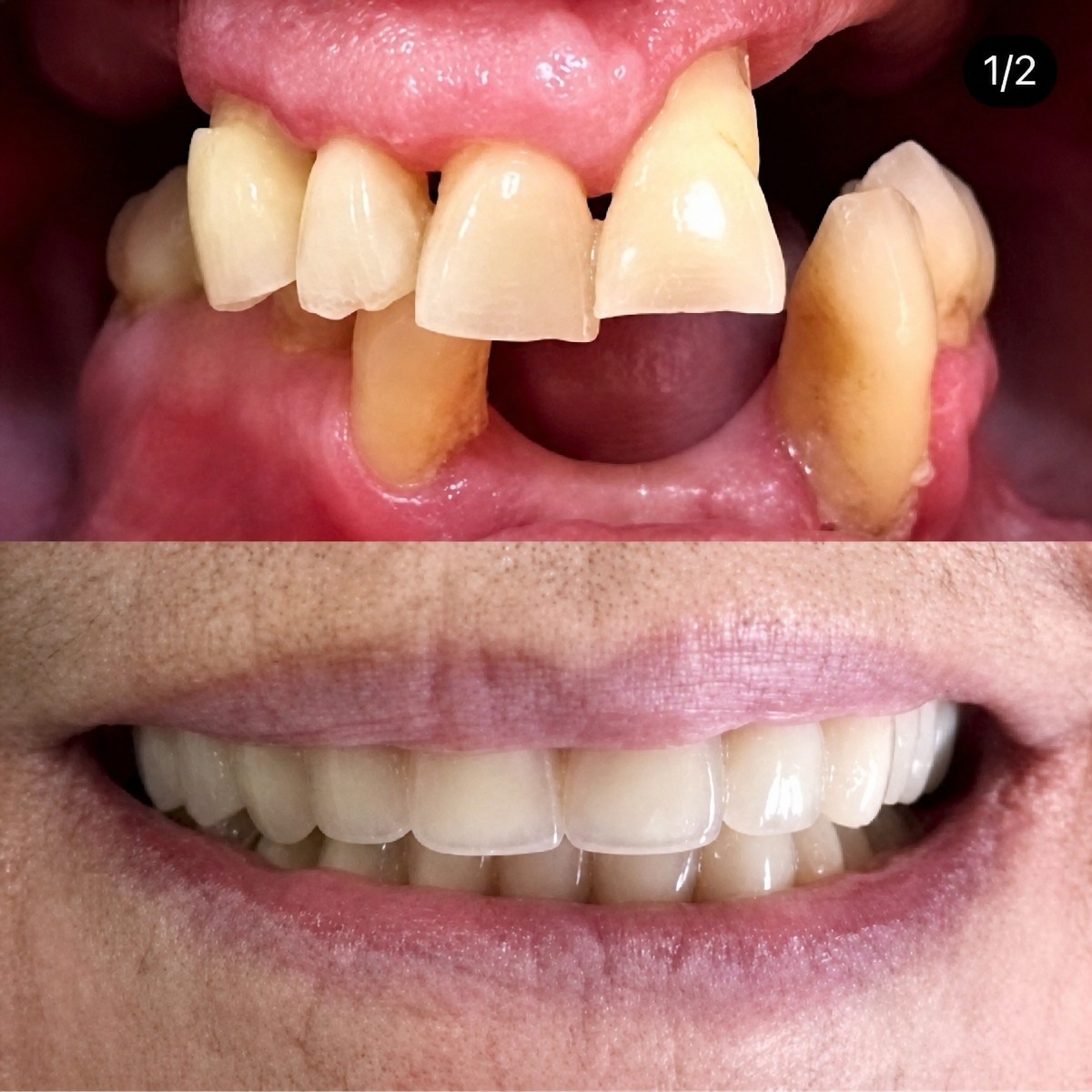 Résultats avant et après prothèse dentaire à Professional Dental Care Clinic, sourire restauré