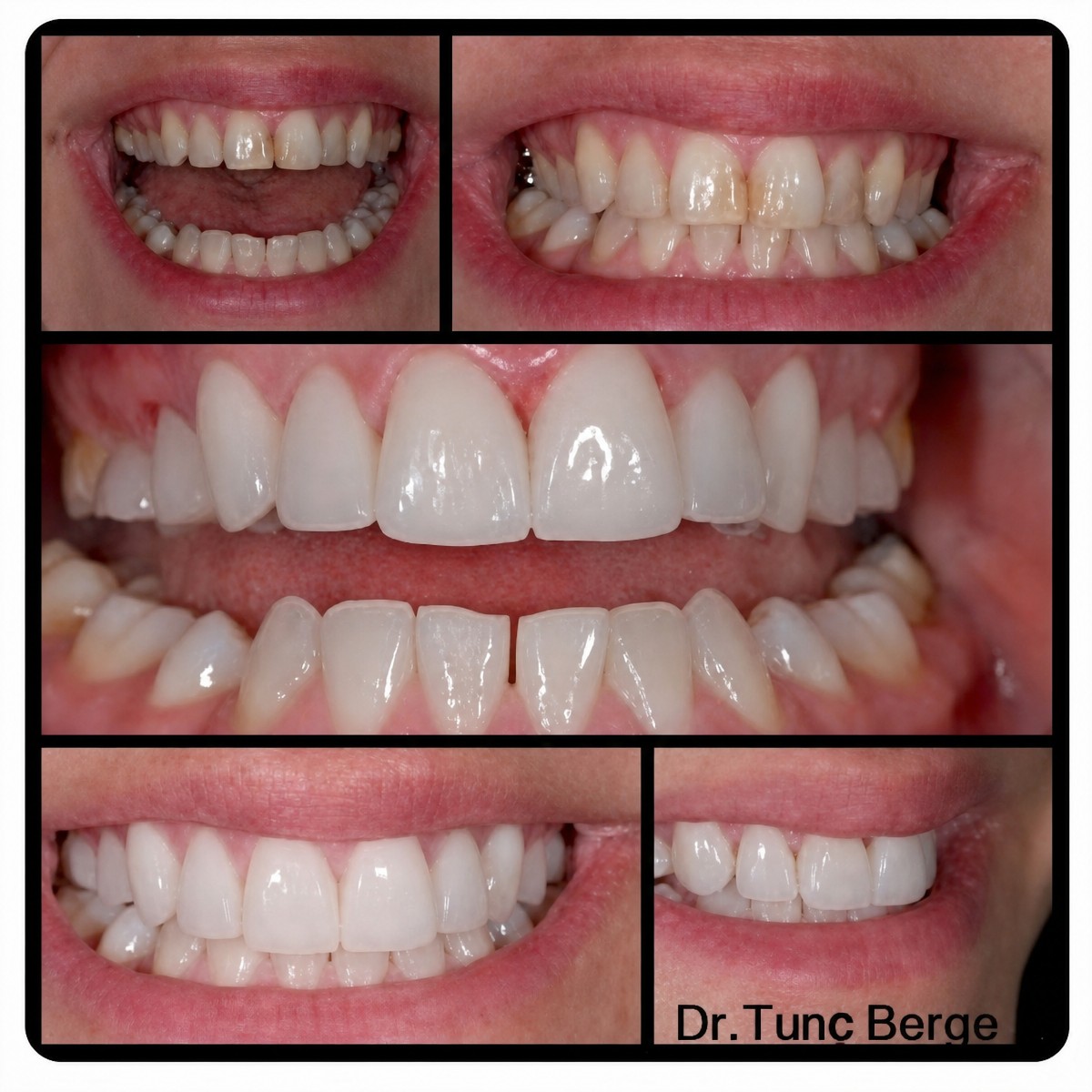 نتائج قبل وبعد الفينير في Bergedent Esthetic Dentistry and Implantology Clinic