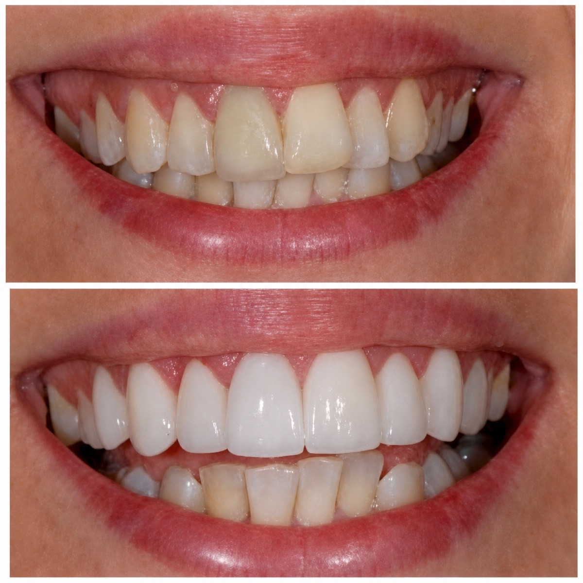 نتيجة قبل وبعد الفينير في Bergedent Esthetic Dentistry and Implantology Clinic، تجميل الابتسامة