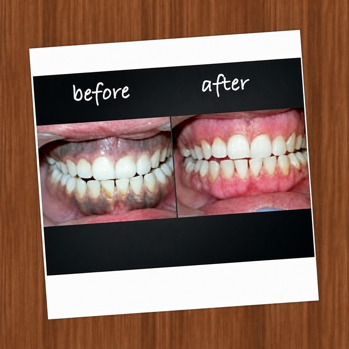 نتائج تبييض الأسنان قبل وبعد في Bergedent Esthetic Dentistry and Implantology Clinic