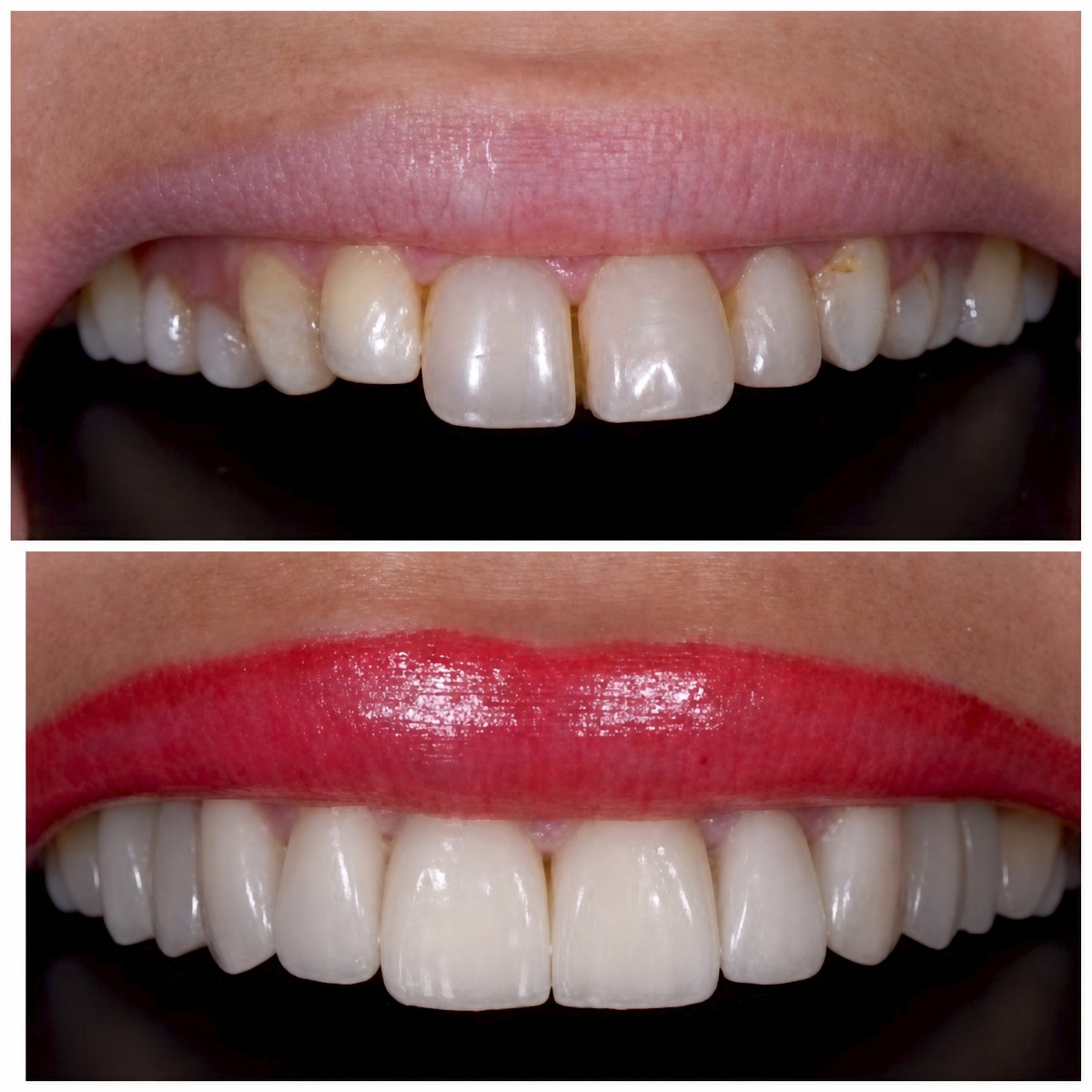 نتيجة قبل وبعد الفينير في Bergedent Esthetic Dentistry and Implantology Clinic، تجميل الابتسامة