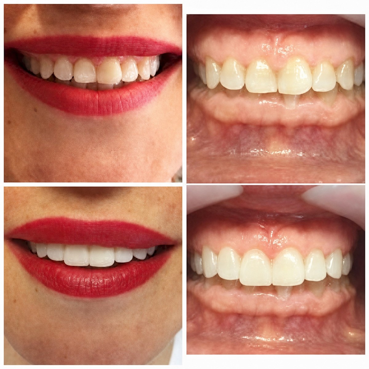 نتائج قبل وبعد قشور البورسلين في عيادة Bergedent Esthetic Dentistry and Implantology