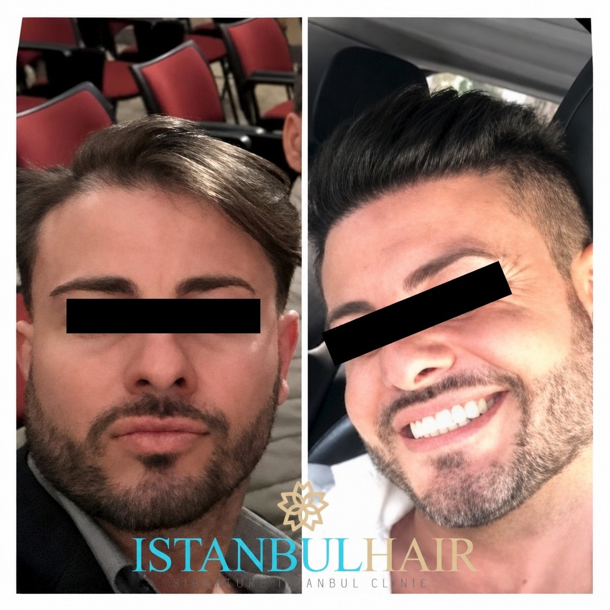 نتائج زراعة الشعر FUE قبل وبعد في Euro İstanbul Medical Group، كثافة شعر محسنة