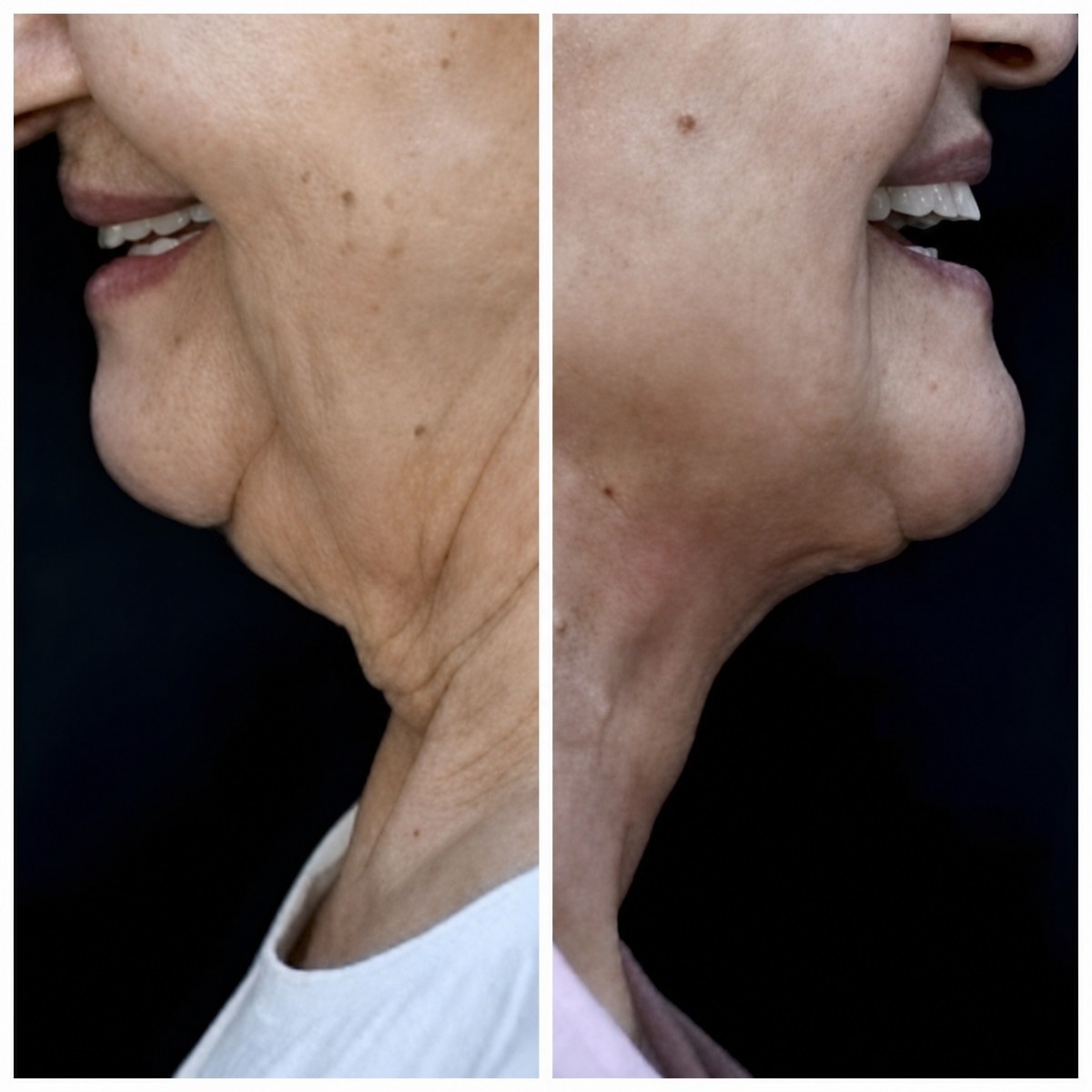 Before and after liposuction results at Op. Dr. Ayse oznur akidil clinic, neck contour improved