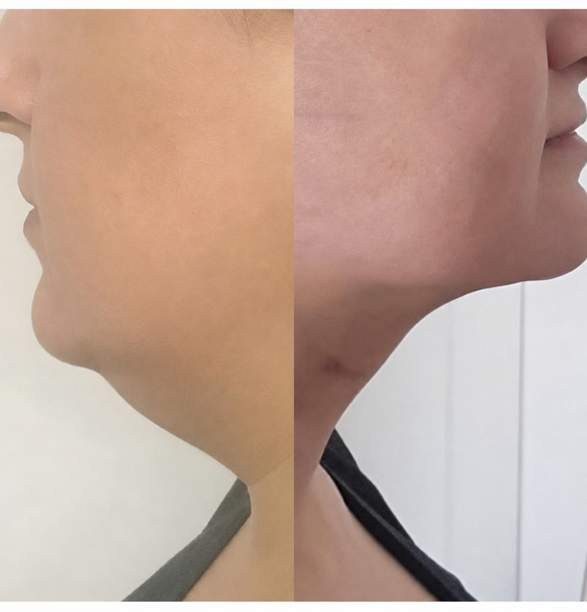 Before and after neck liposuction results at Op. Dr. Ayse oznur akidil clinic, improved jawline