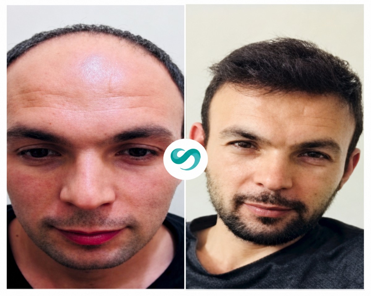 Resultados de trasplante capilar antes y después en SALUSS Medical Group, línea natural restaurada