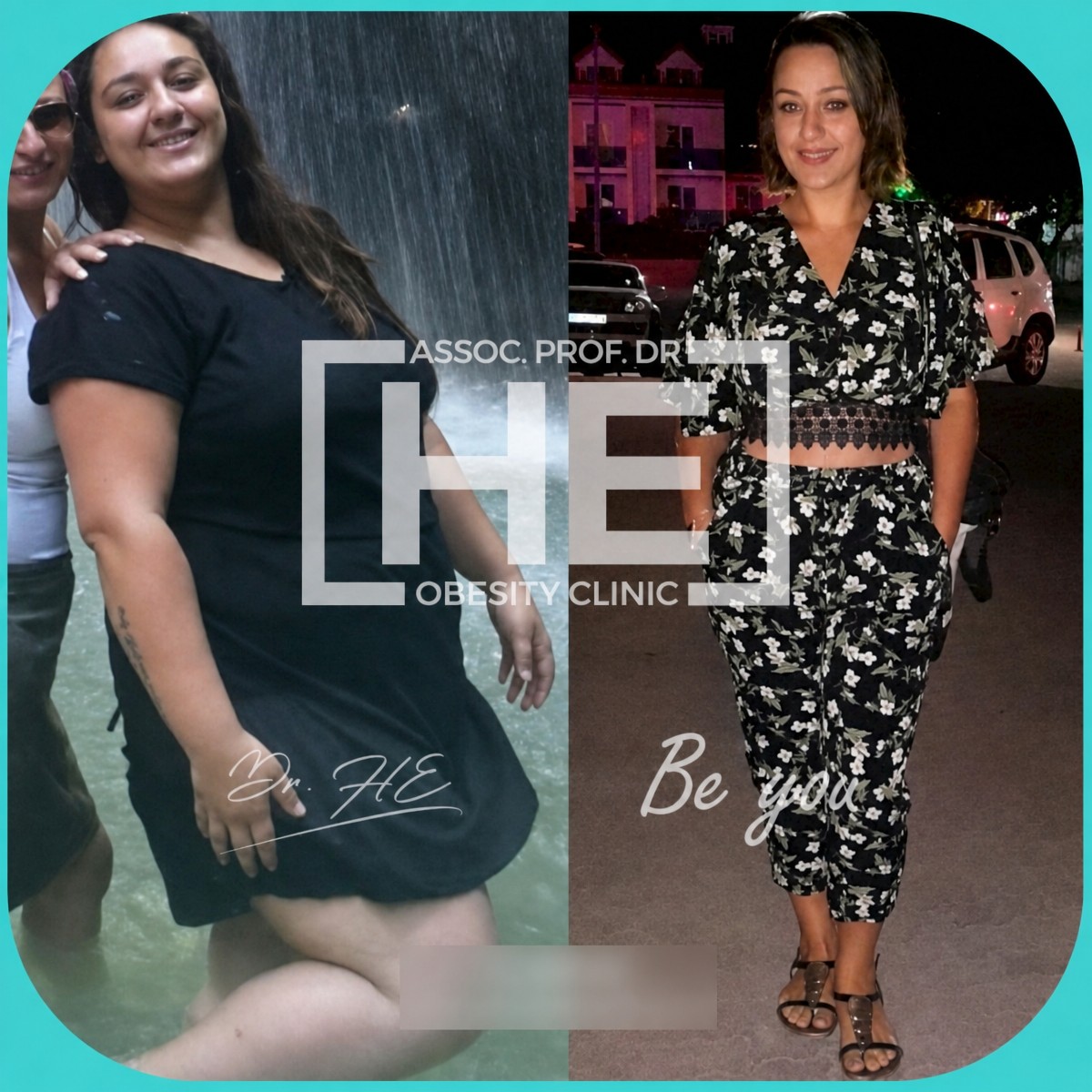 نتائج قبل وبعد تكميم المعدة في Dr. HE Obesity Clinic، فقدان وزن ملحوظ