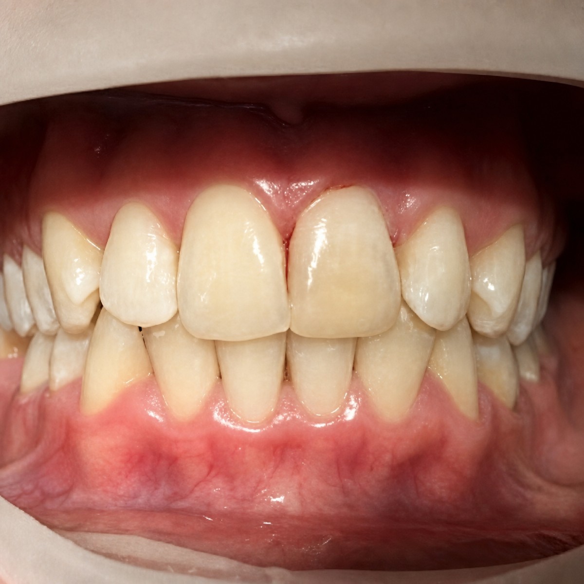 Результат композитных виниров в NGY Med Dental Clinic – улучшена форма и цвет зубов