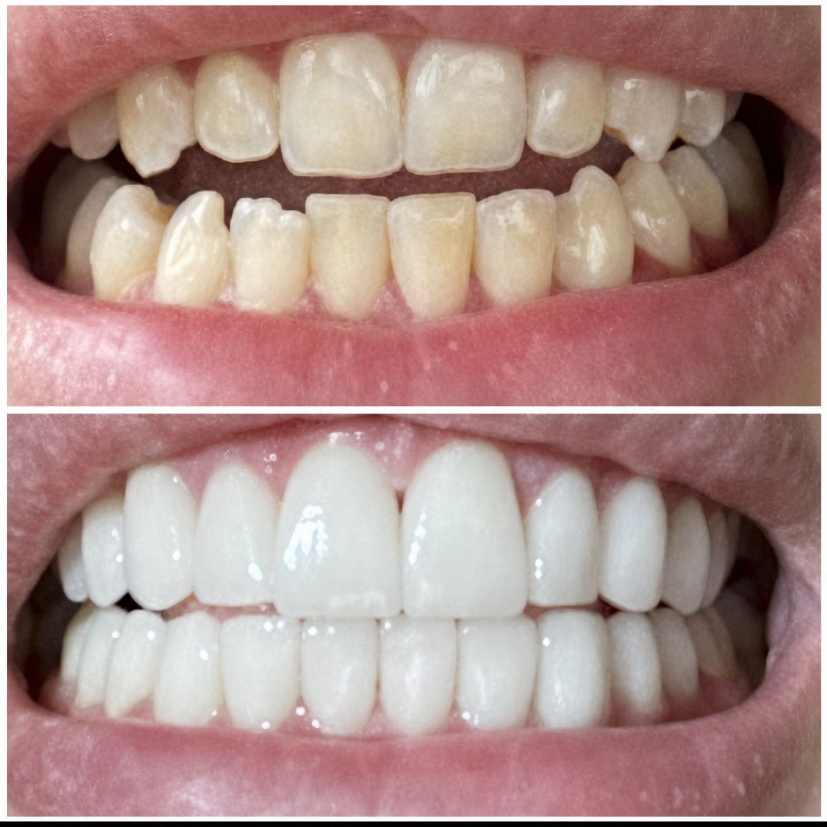 نتائج قبل وبعد عدسات الأسنان الخزفية في عيادة Dentsuadiye Dental Clinic، تحول الابتسامة