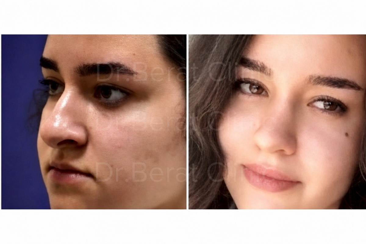 Before and after mini facelift results at SALUSS Medical Group, facial rejuvenation visible