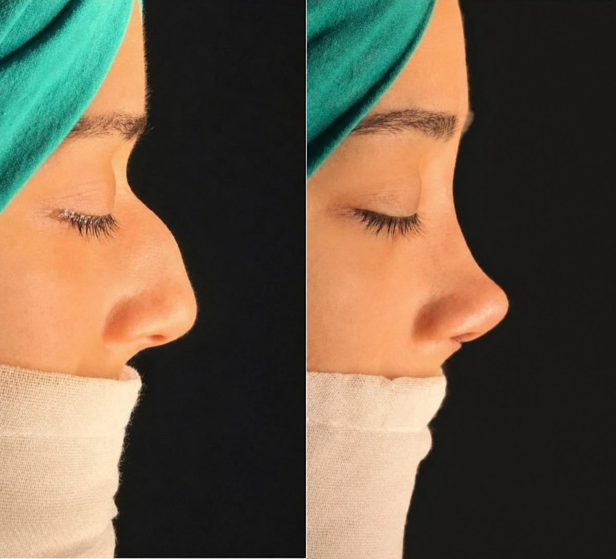 نتائج تجميل الأنف قبل وبعد في عيادة Medipunto، تحسين شكل ومظهر الأنف