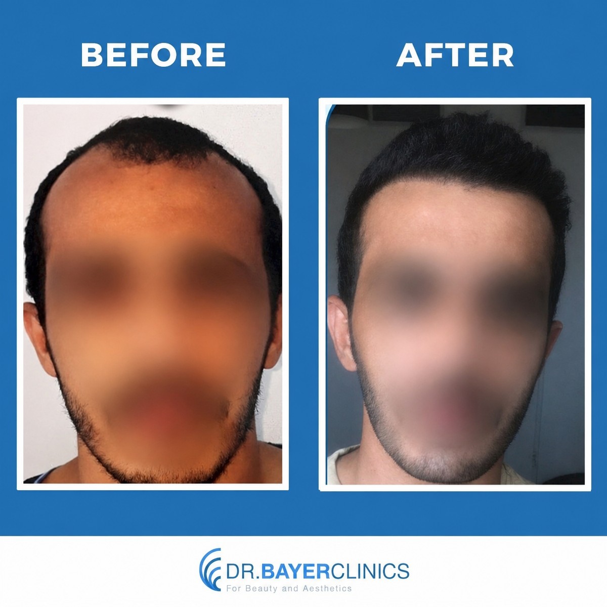 Before and after DHI hair transplant results at Dr. Bayer Clinic Beauty & Aesthetic, fuller hairline