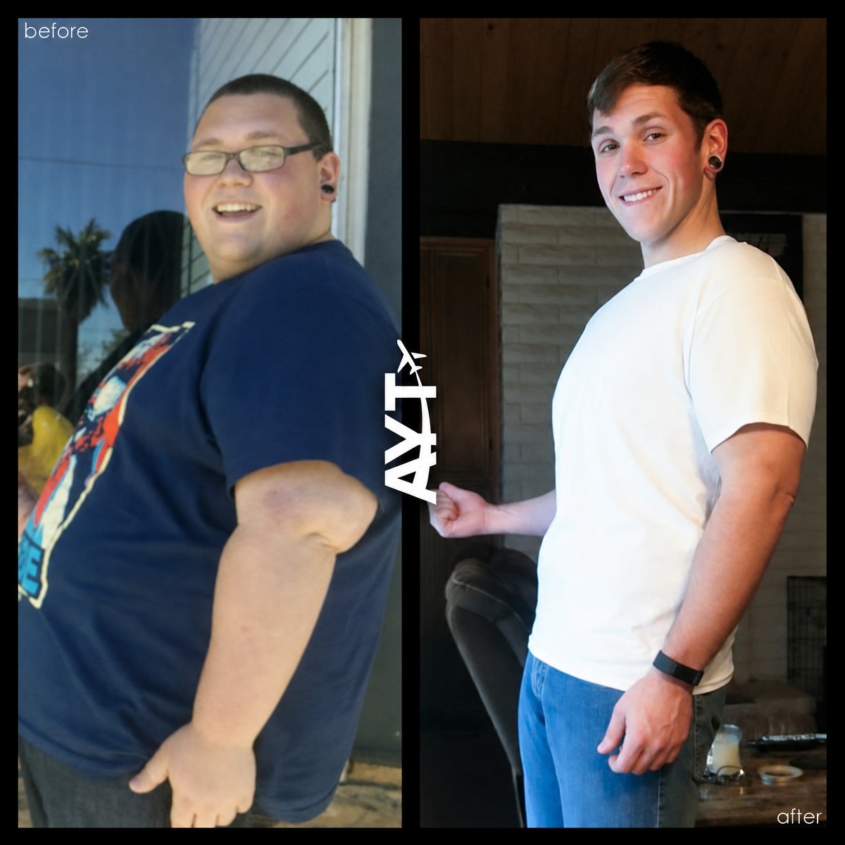 Antes y después de manga gástrica en AYT Clinic – resultados de pérdida de peso notable