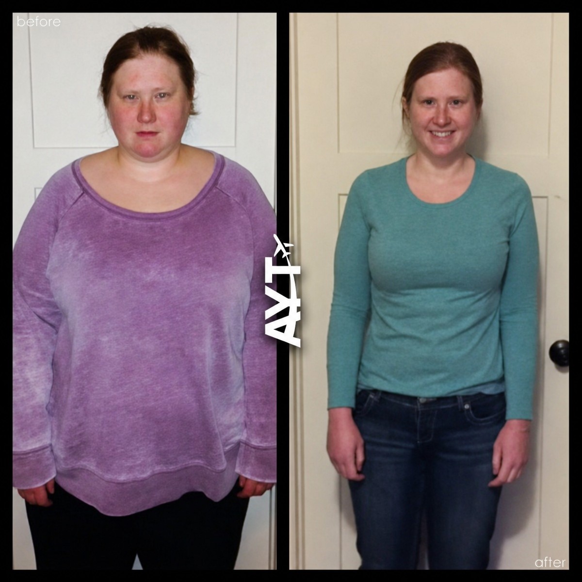 Before and after gastric bypass results at AYT Clinic – significant weight loss transformation