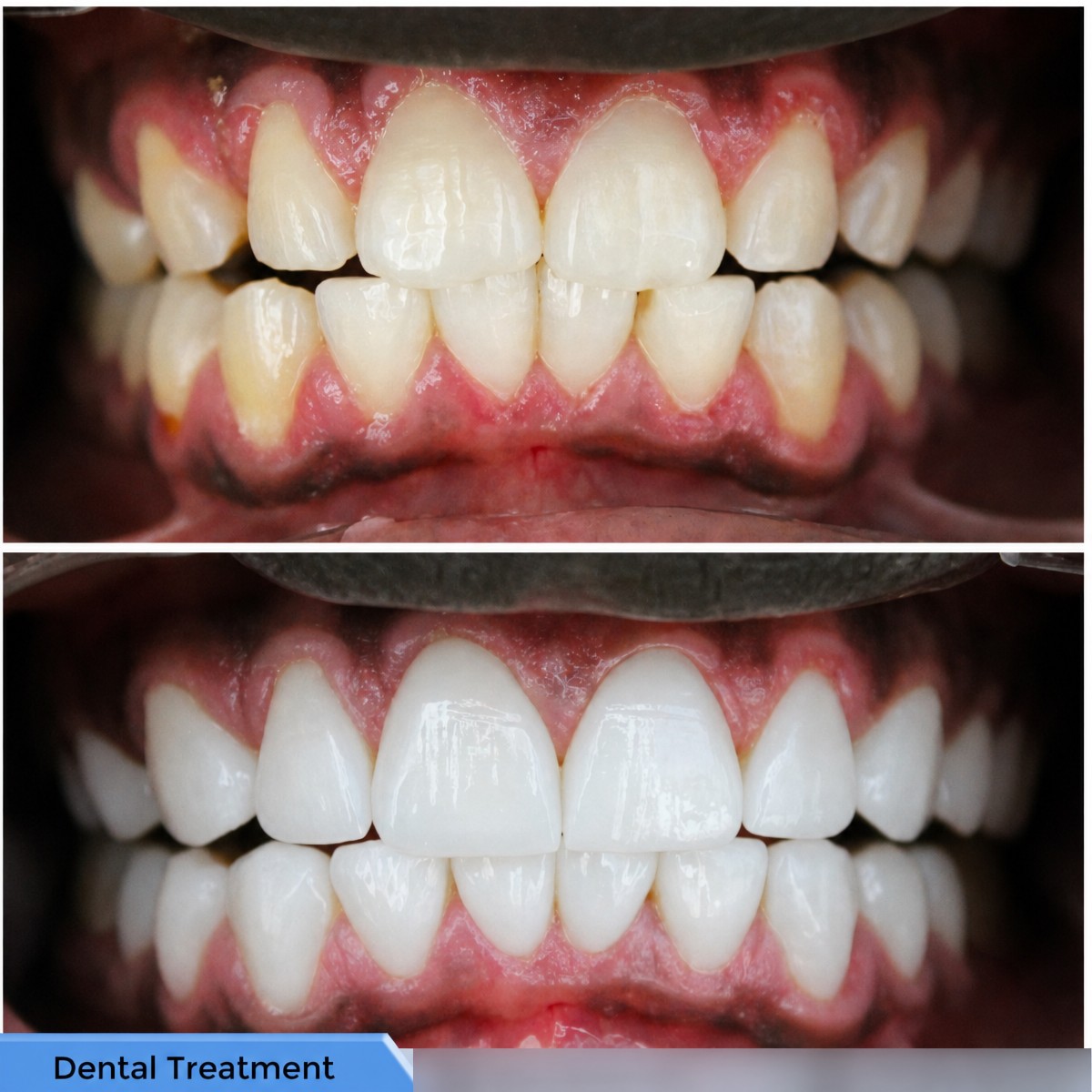 До и после установки виниров в Akdeniz Inci Dental Clinic – эстетика улыбки улучшена