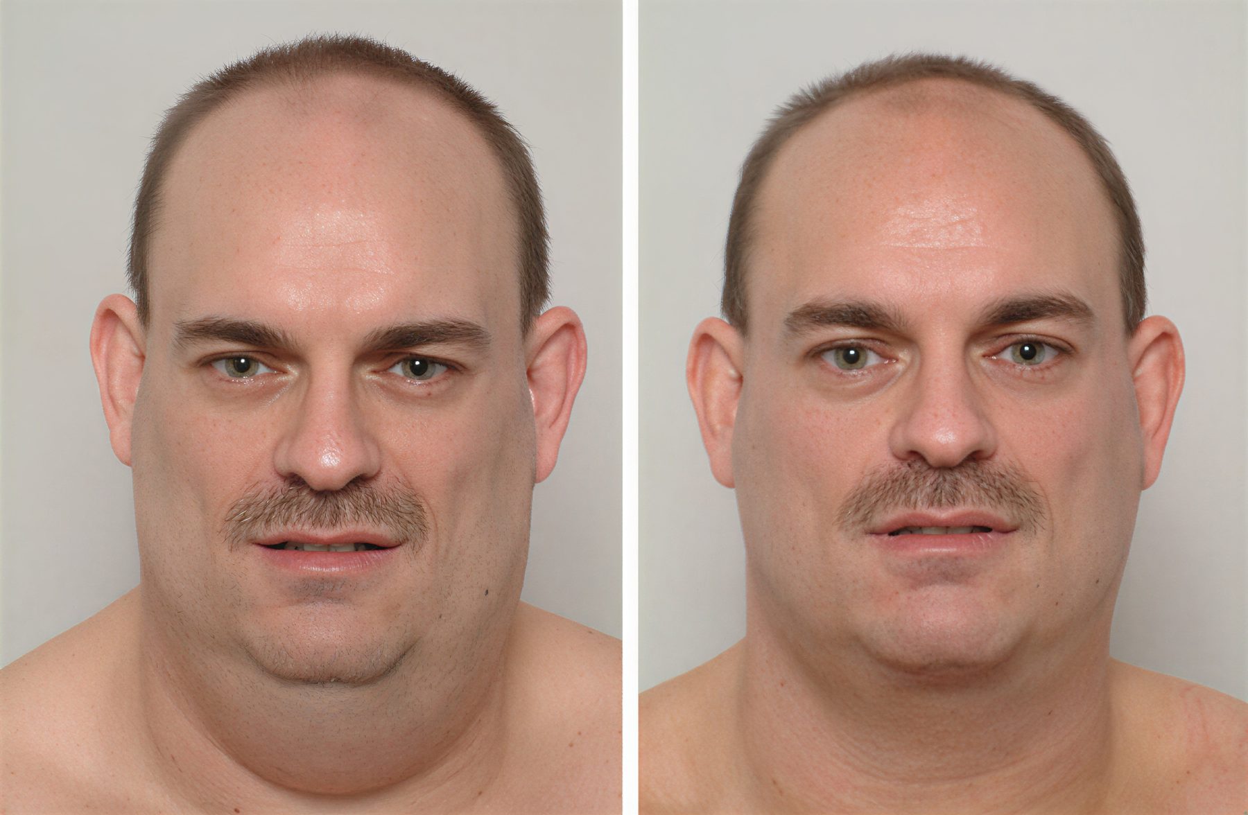 Resultados de liposucción de cuello antes y después en Parla Clinic – mejora del contorno mandibular