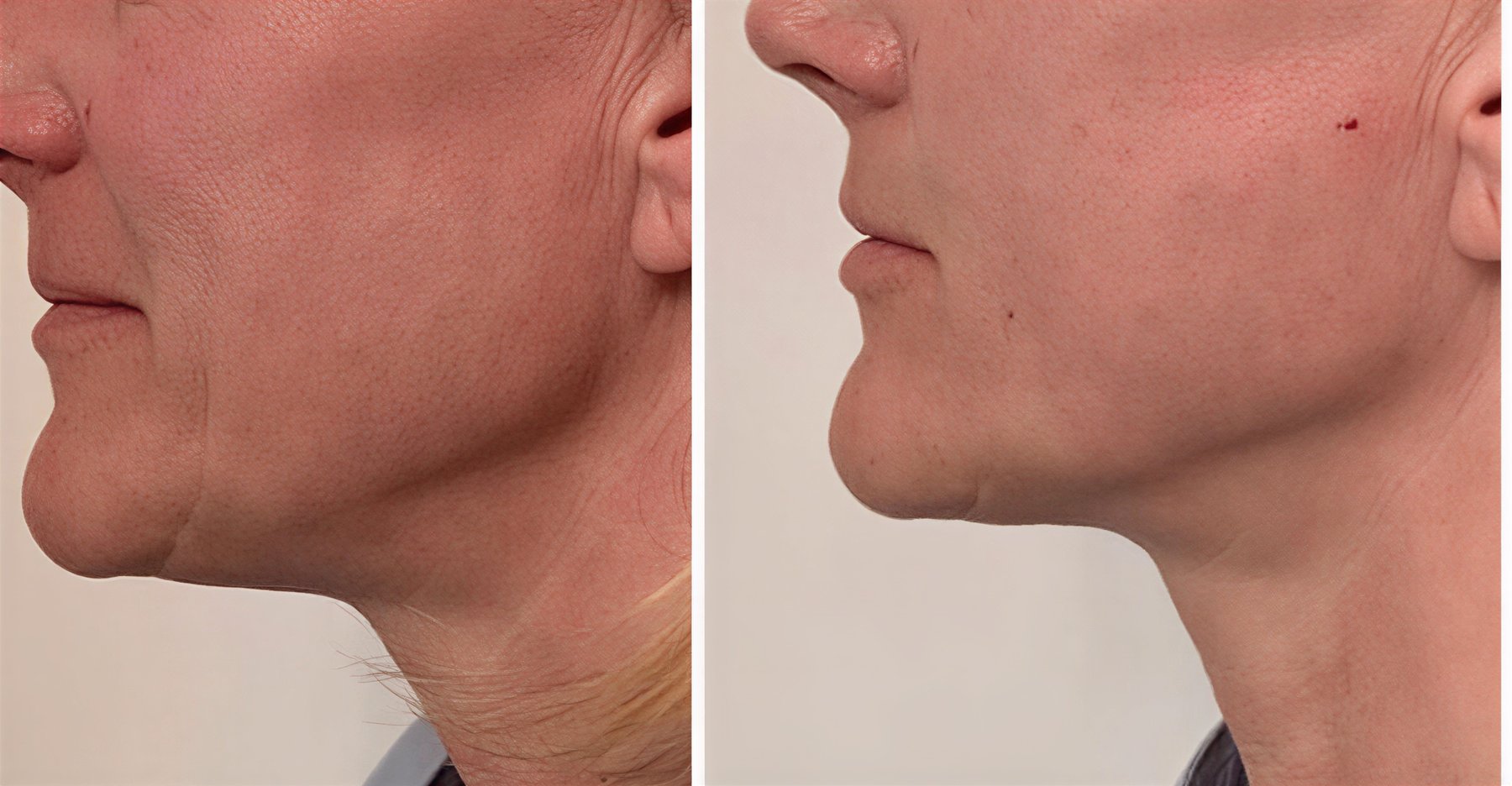 Resultados de liposucción de cuello antes y después en Parla Clinic – mandíbula definida