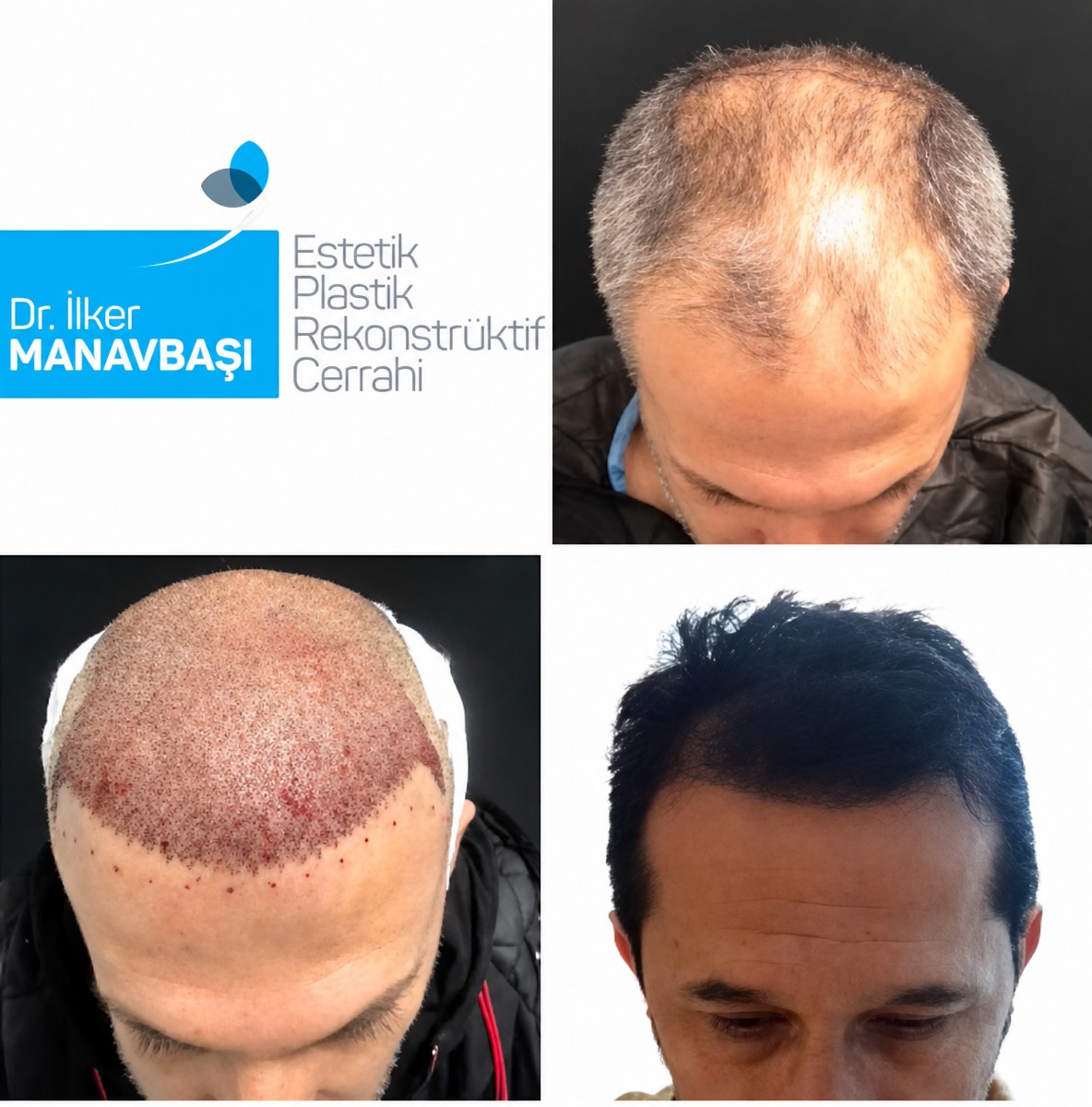 Resultados de trasplante capilar DHI antes y después en la clínica Dr. Ilker Manavbasi, mayor densidad