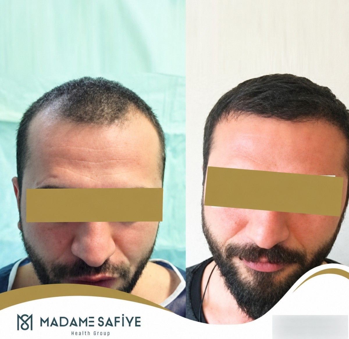 نتائج قبل وبعد زراعة الشعر FUE في عيادة Madame Safiye، كثافة شعر محسنة