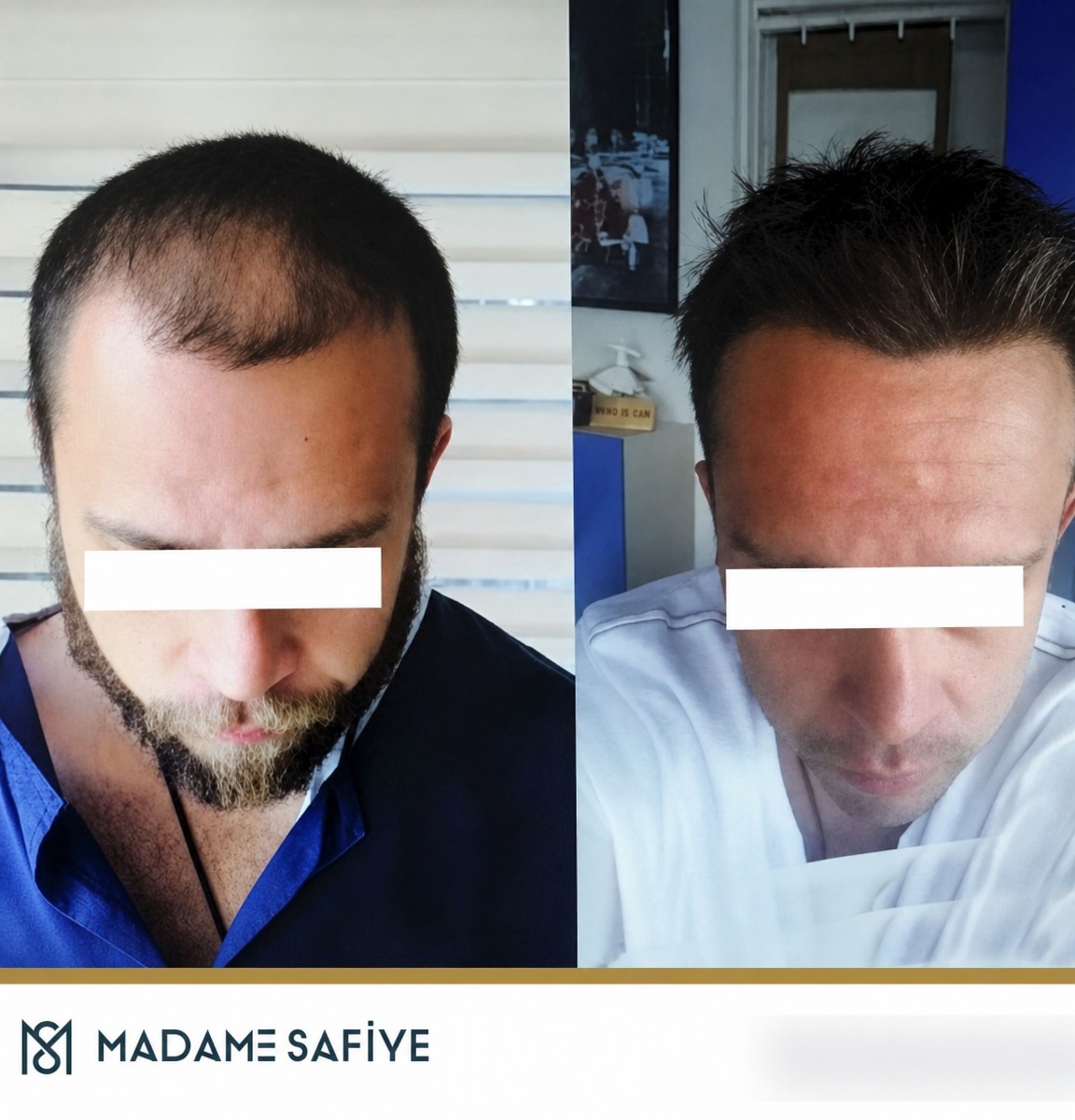 نتائج قبل وبعد زراعة الشعر بتقنية DHI في عيادة Madame Safiye، كثافة محسنة