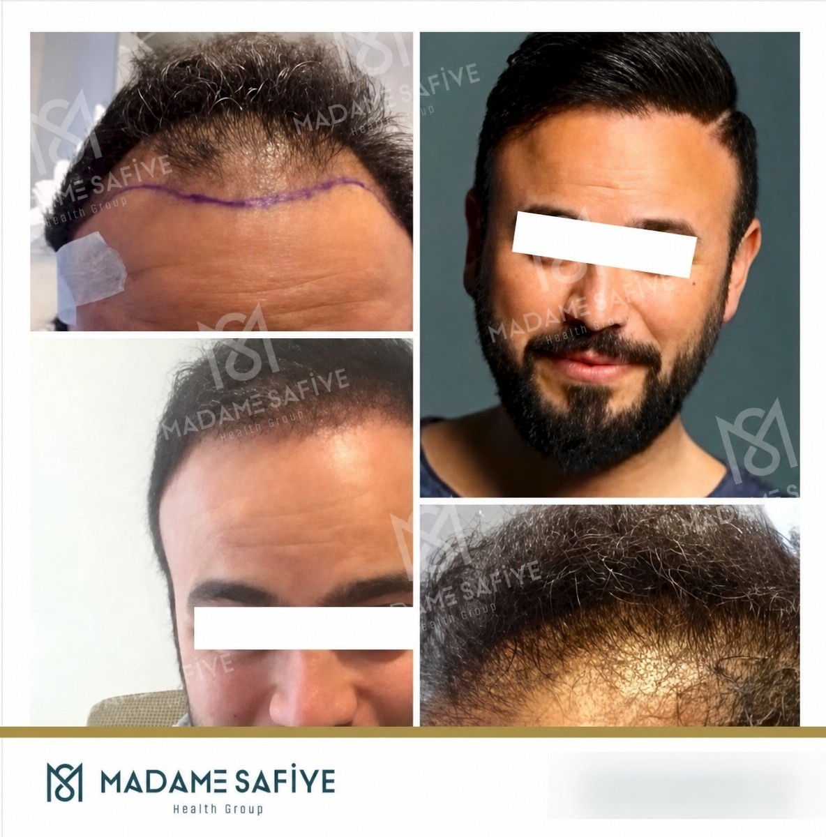 Resultados de trasplante capilar FUE antes y después en Madame Safiye Clinic, línea restaurada