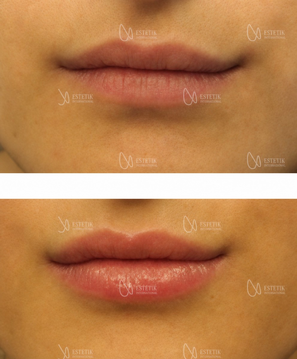 Avant-après injections de fillers lèvres chez Estetik International Istanbul, volume augmenté