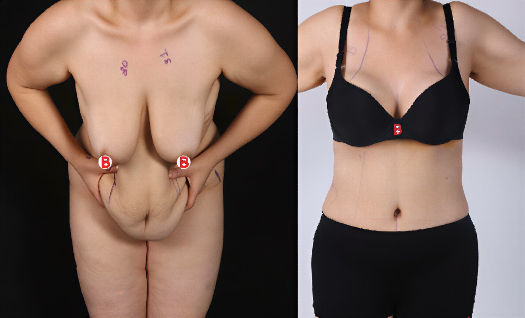 Resultados antes y después de mommy makeover en Estetik International Istanbul – mejora corporal