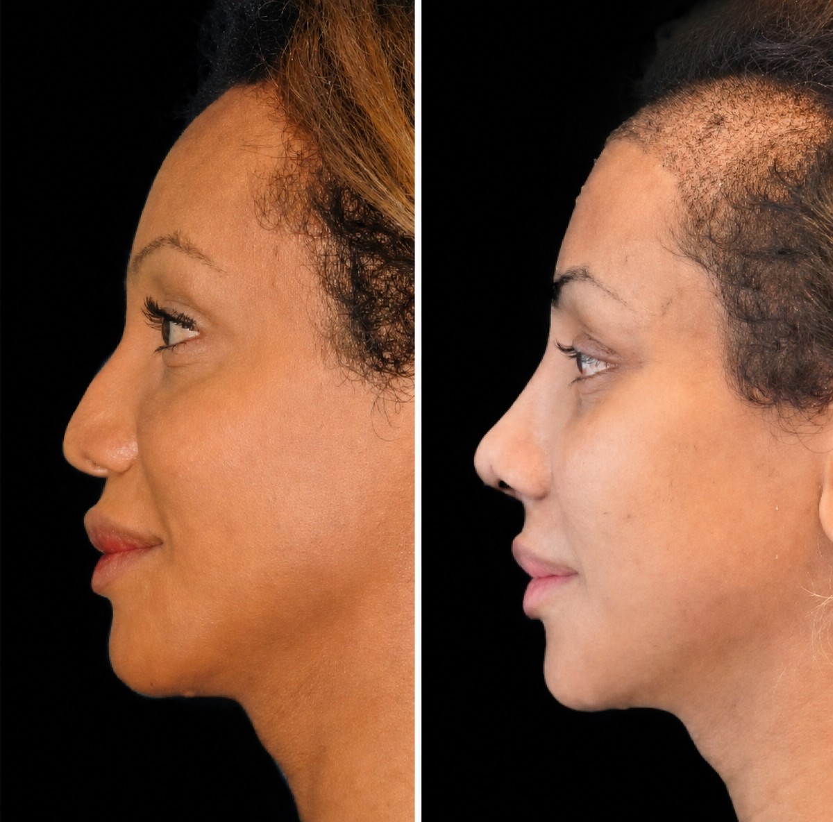 Afro-Haartransplantation Vorher-Nachher-Ergebnisse in Dr. Ilker Manavbasi's Klinik, verbesserter Haaransatz