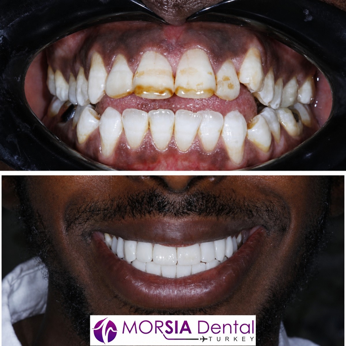 Before and after veneers at Morsia Dental Clinic – smile transformation and whiter teeth result