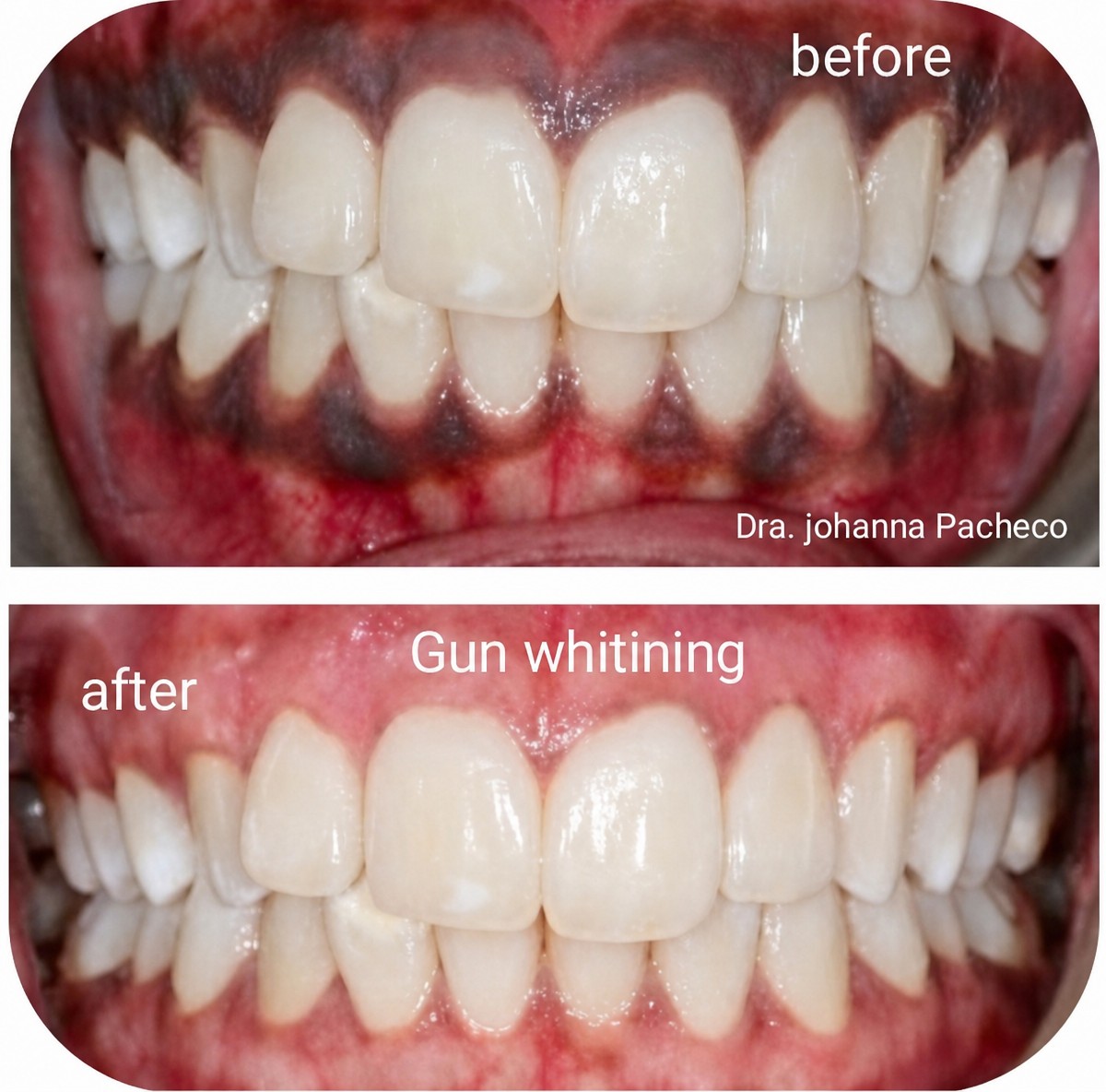 Efekty przed i po wybielaniu dziąseł w Love Dental and Sthetic Clinic, jaśniejszy uśmiech
