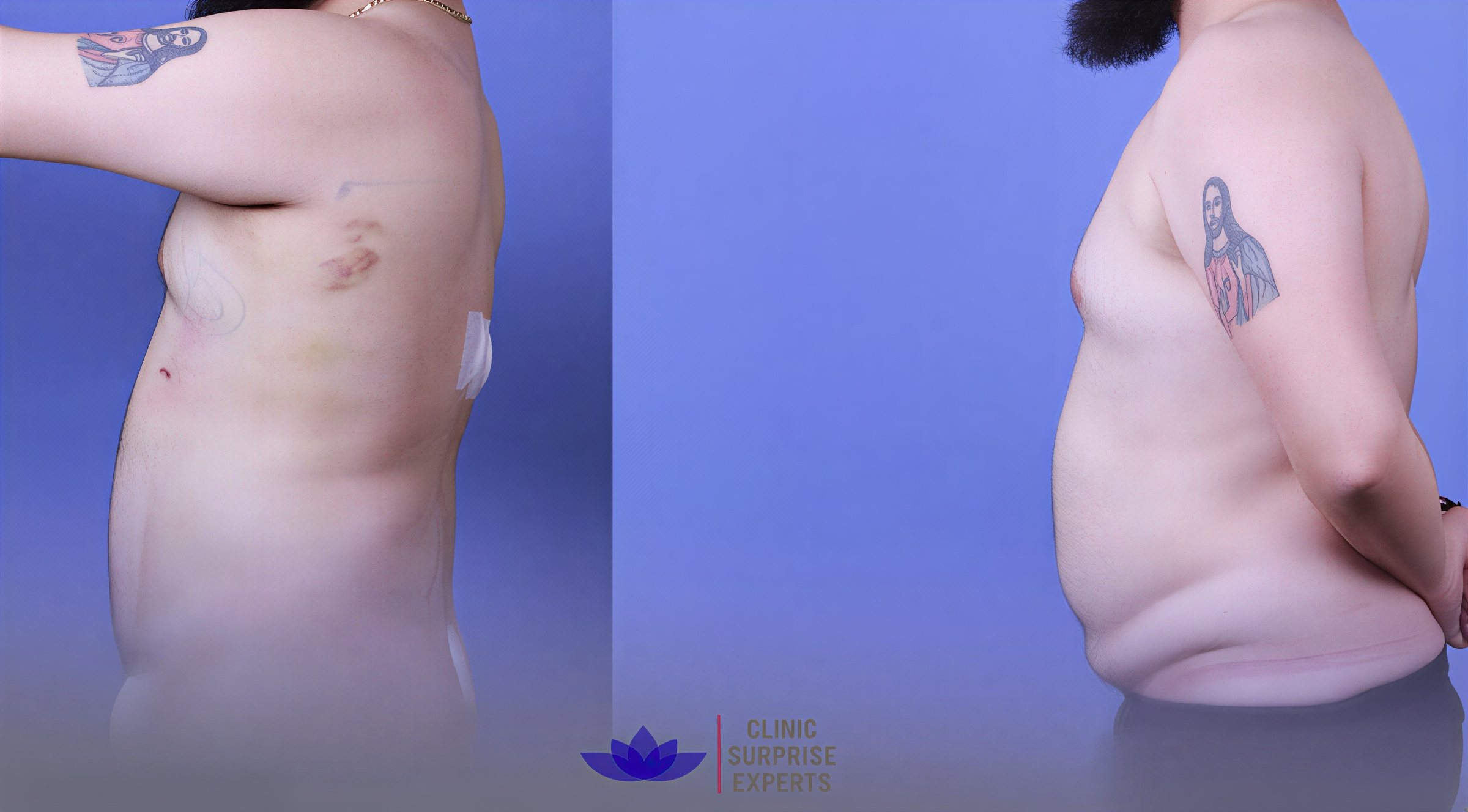 Resultados de abdominoplastia antes y después en Surprise Experts Clinic, mejora abdominal visible