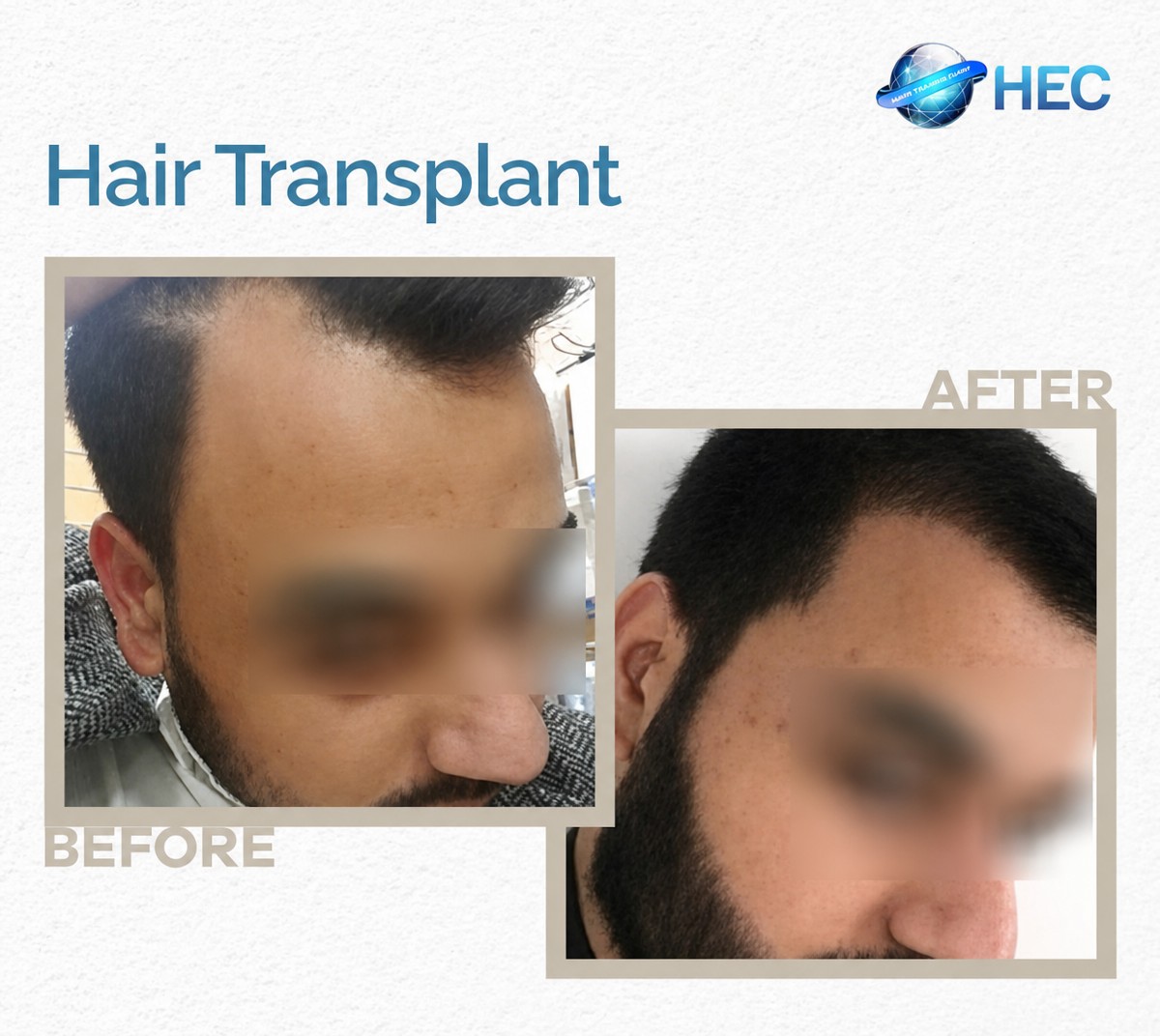 Résultats avant et après greffe de cheveux chez HEC Turkey, ligne capillaire restaurée
