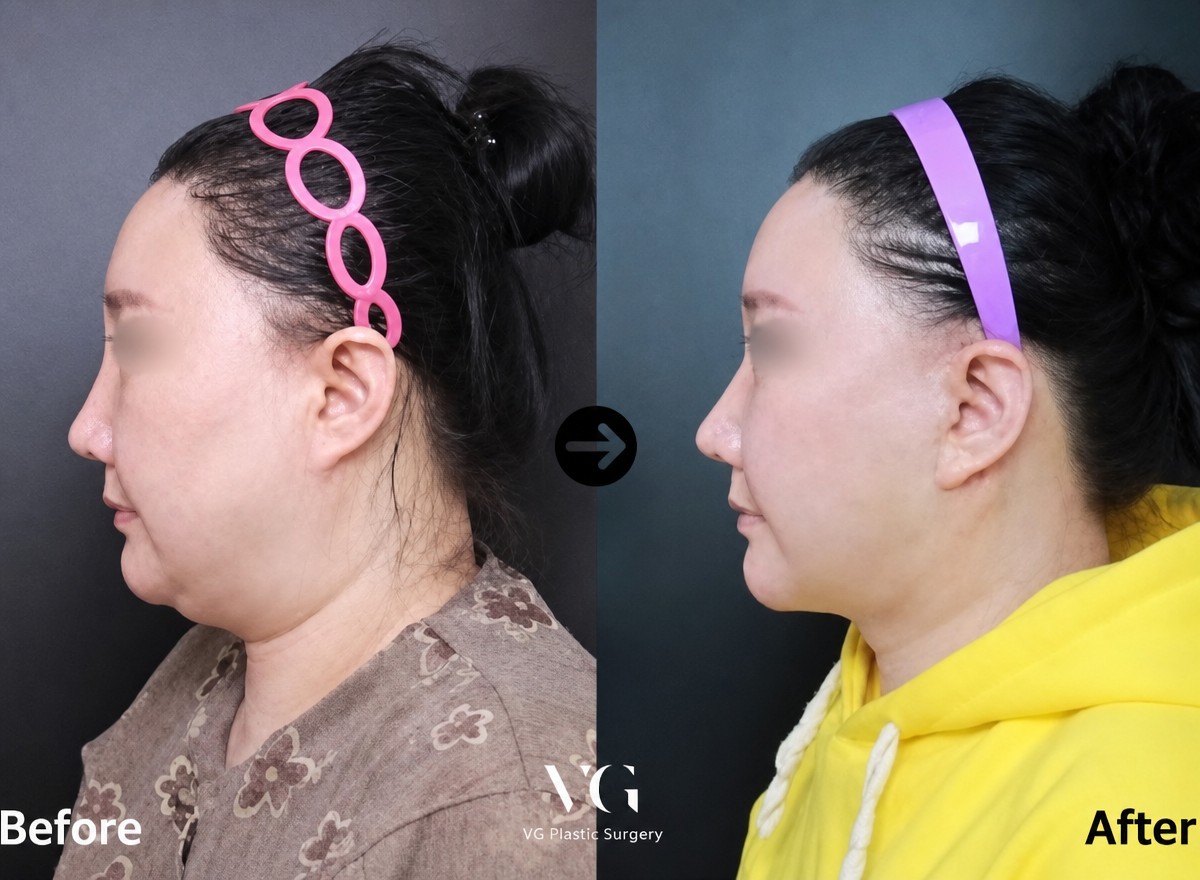 Результаты липосакции шеи до и после в VG Plastic Surgery, улучшение контура подбородка