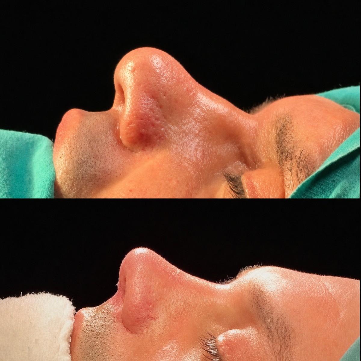نتائج قبل وبعد عملية تجميل الأنف التصحيحية في Medipunto Clinic، شكل أنف محسّن