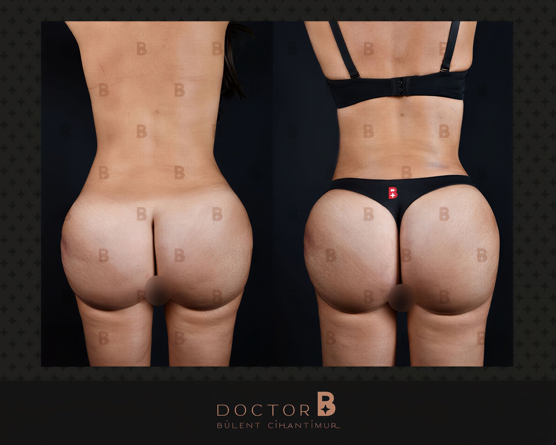Resultados antes y después de liposucción y abdominoplastia en Doctor B Clinic, mejor contorno corporal
