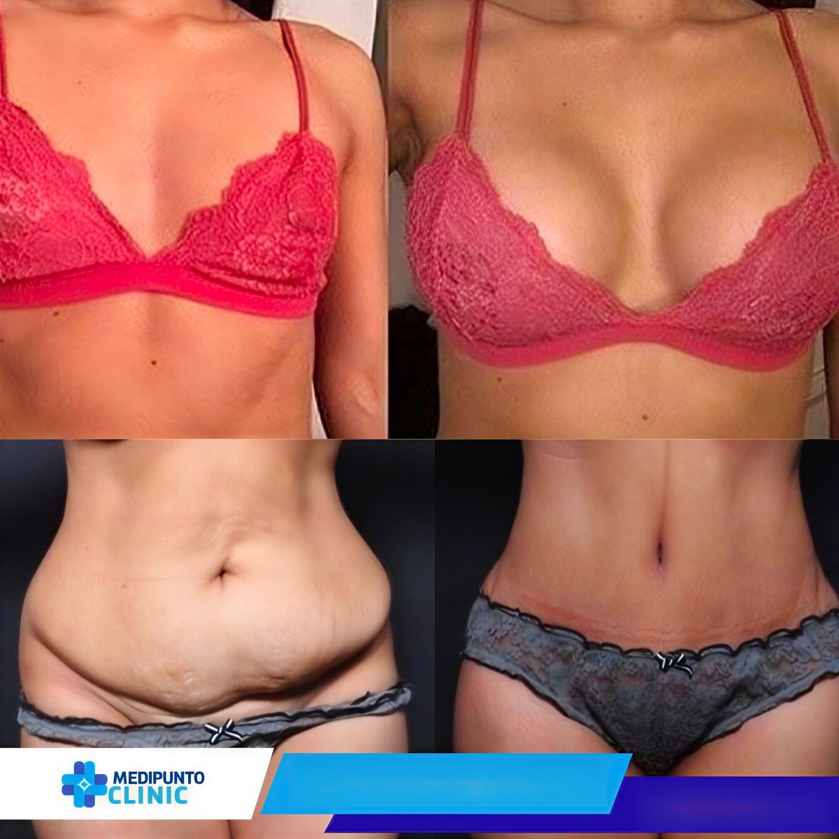 Resultados antes y después de abdominoplastia, liposucción y aumento de senos en Medipunto Clinic